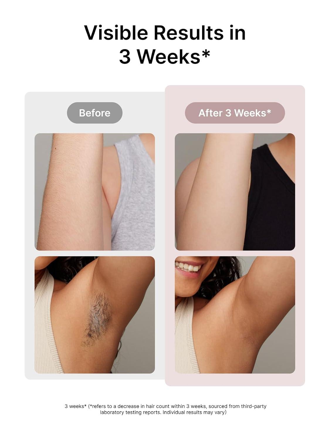 image:imageUlike Laser Hair Removal for Women and Men Air 3 IceCooling IPL Device Hair Removal for Nearly Painless amp LongLasting Results 3 Modes amp Auto Flashing for Fast Full Body Hair Removal from HomePink
