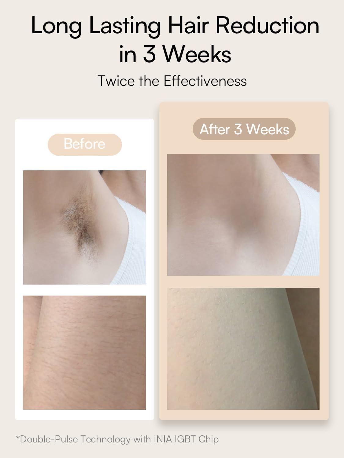 image:imageINIA Laser Hair Removal for Women and Men IPL Hair Removal Device with IceCooling Double Effectiveness amp 5 Flashes per Second for LongLasting and Nearly Painless ResultsWhite